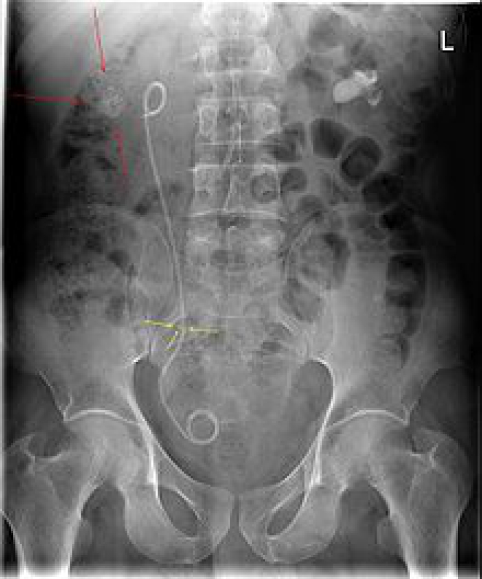 Röntgenfoto met een dubbel J katheter