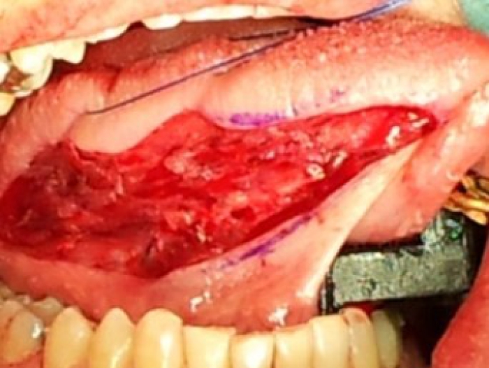 Foto toont het weggenomen stukje tongslijmvlies in de mond. 